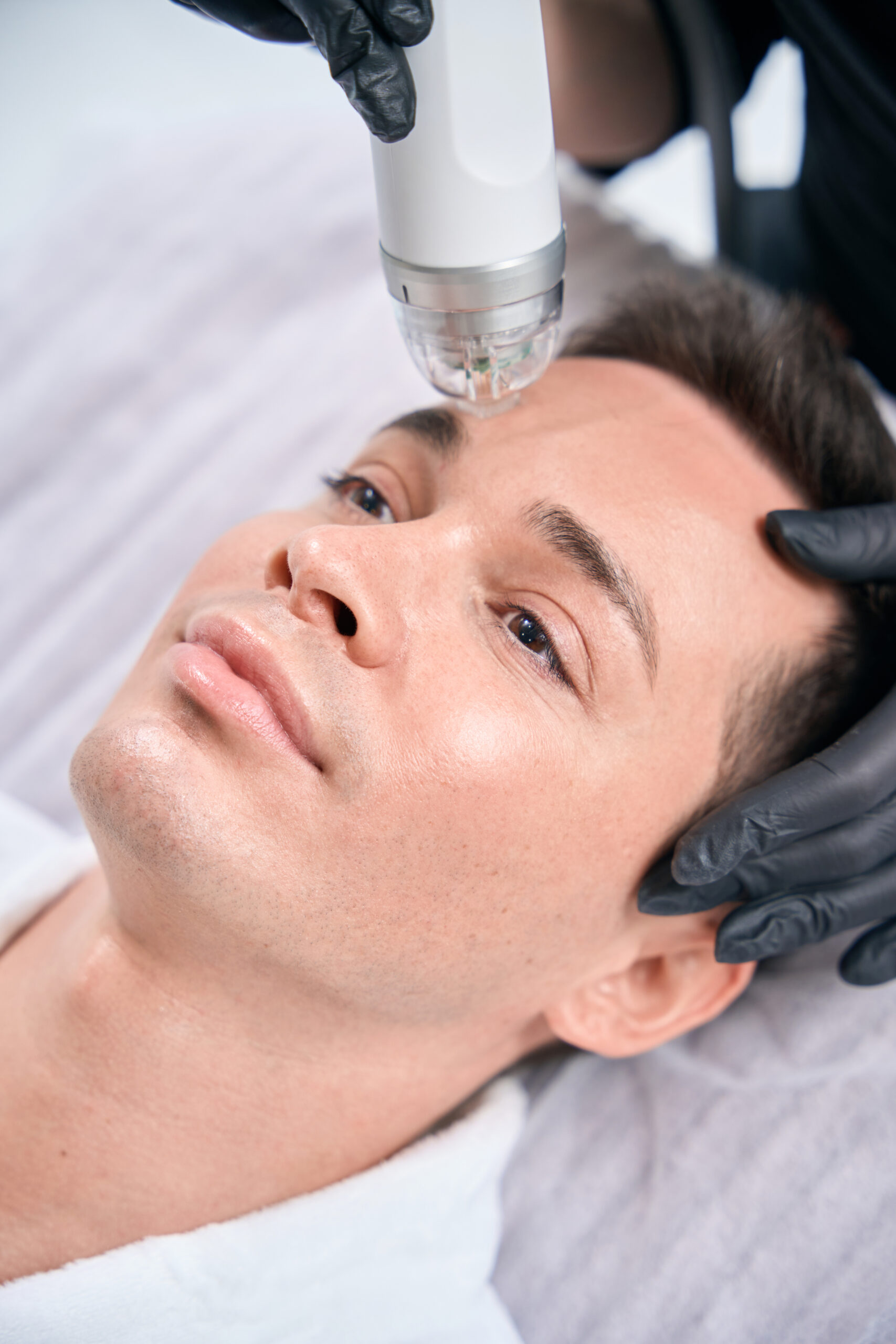 Lumi PLEXEL RF microneedling