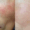 Square Skin United 13 Laser Thread Vein Removal