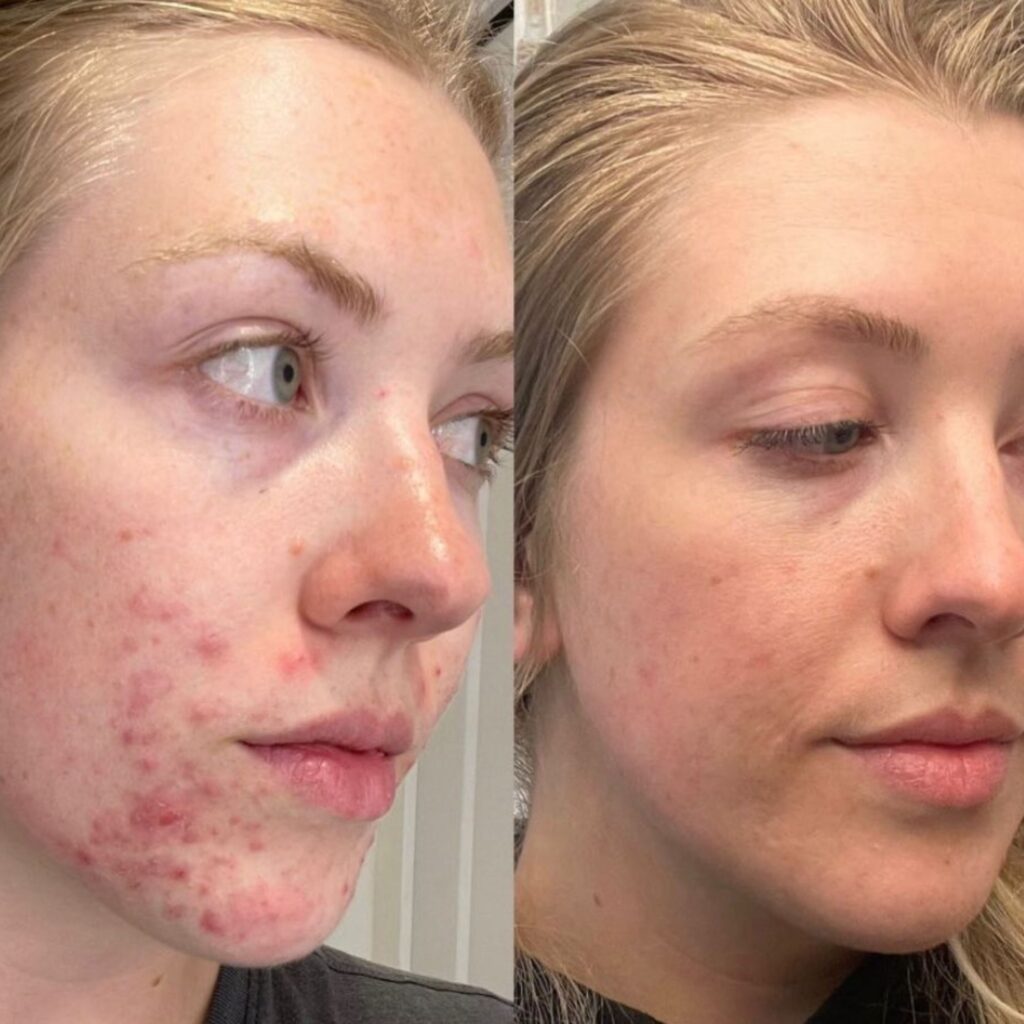 3 Acne