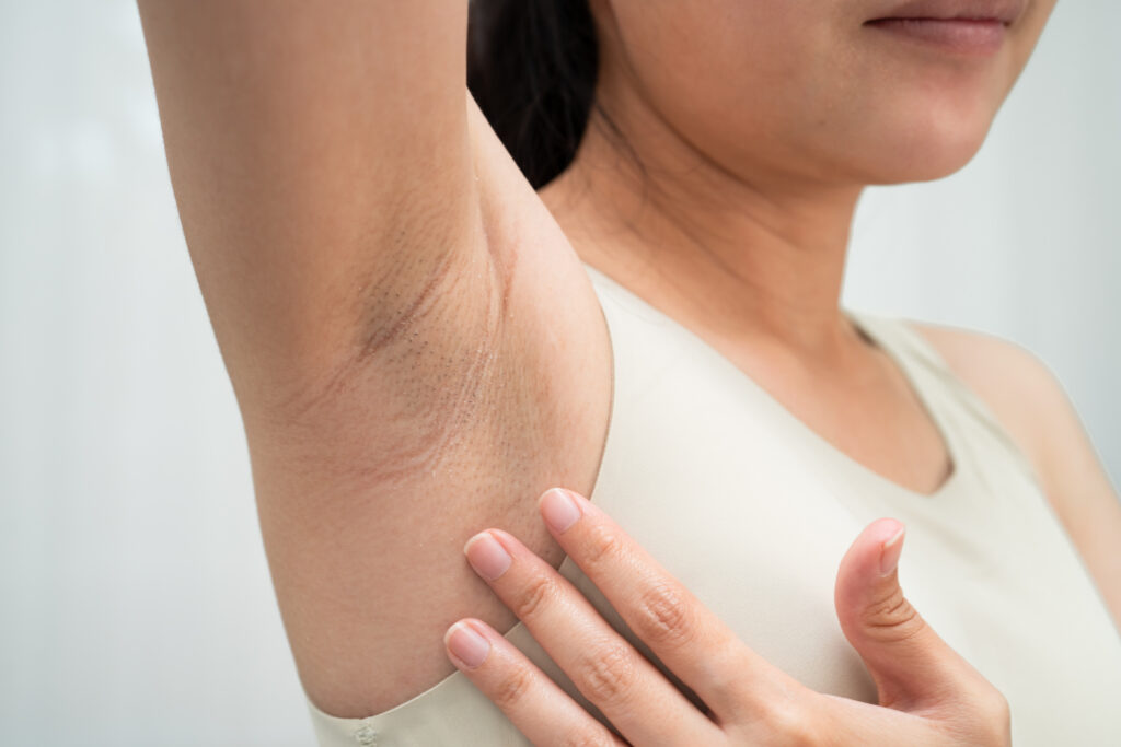 AdobeStock 1918881753 Underarm Sweating Treatment 