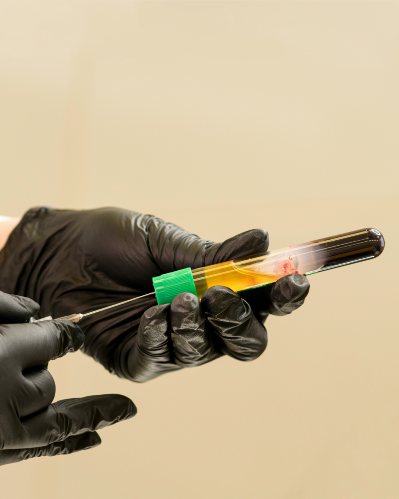 Platelet-rich plasma prepared for a PRP skin treatment
