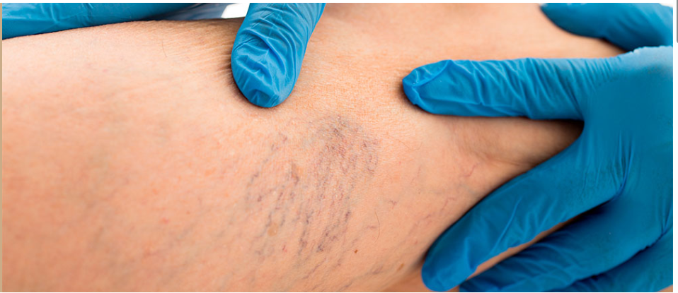 Screenshot 2026 08 27 122450 Laser Thread Vein Removal Lumi Vasale thread vein treatment image supplied by Lumi SKN Clinics