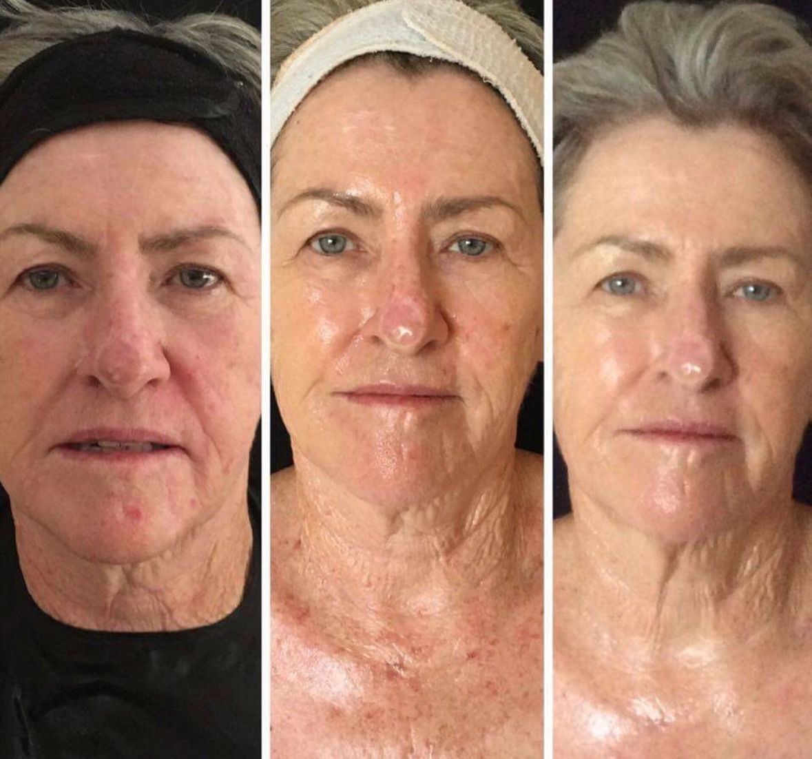 1ebc4aa8 7408 40d2 99d9 a6e696a526a6 Skin Ageing Before and after neck treatment comparison