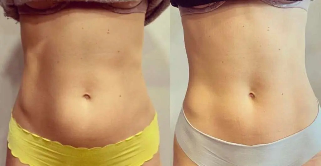 314393392 1097116937631896 2977465815469307314 n 1024x530 1 Weight Loss Before and after abdominal contour comparison