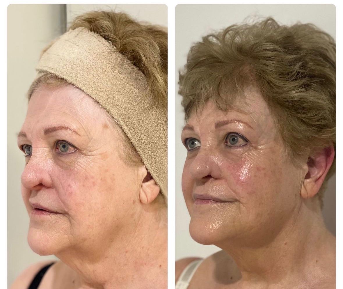 60b21a64 8851 45a5 a7b9 5fdfcd88fa83 Skin Ageing Three-stage facial skin treatment progress comparison