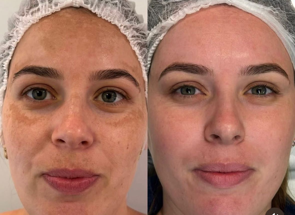 Before and after comparison showing a more even-looking complexion