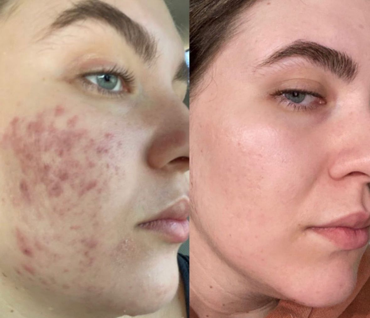 Before and after comparison of active acne