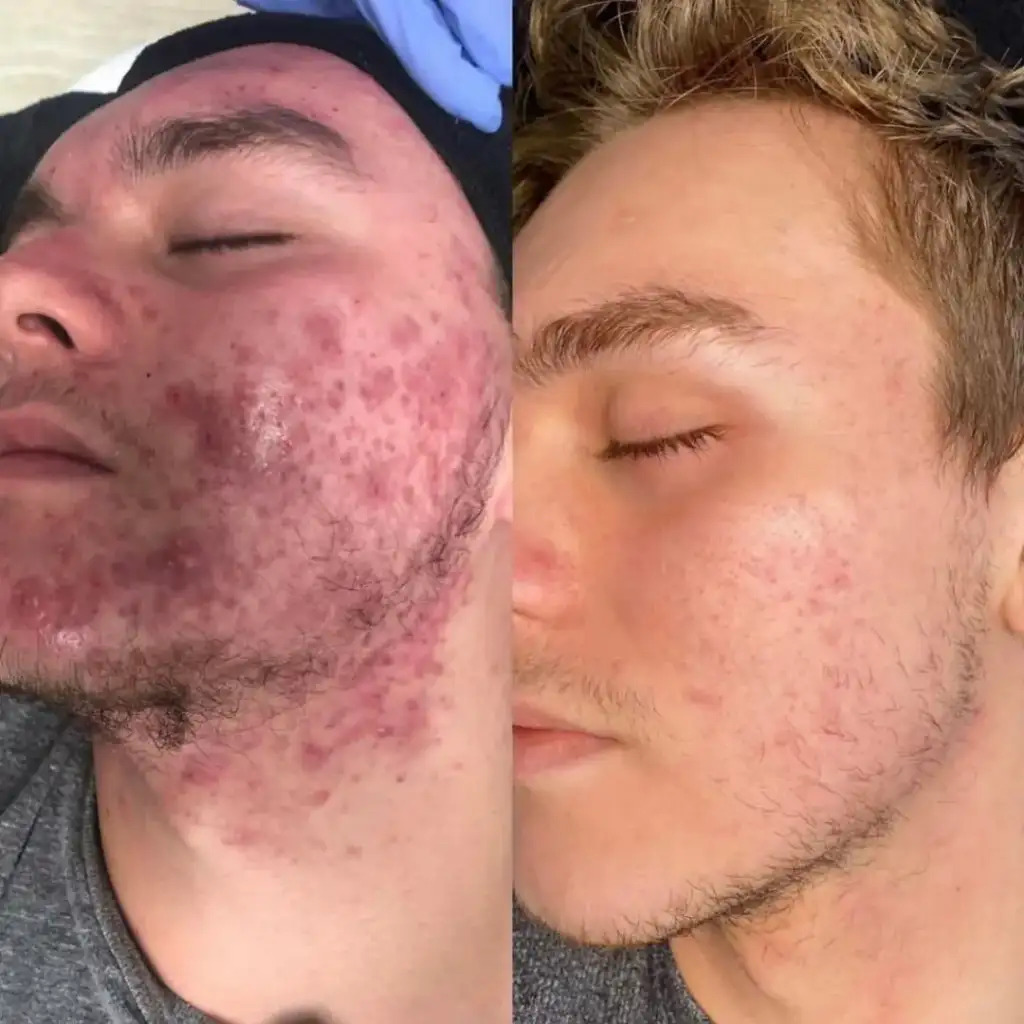 Before and after acne treatment comparison
