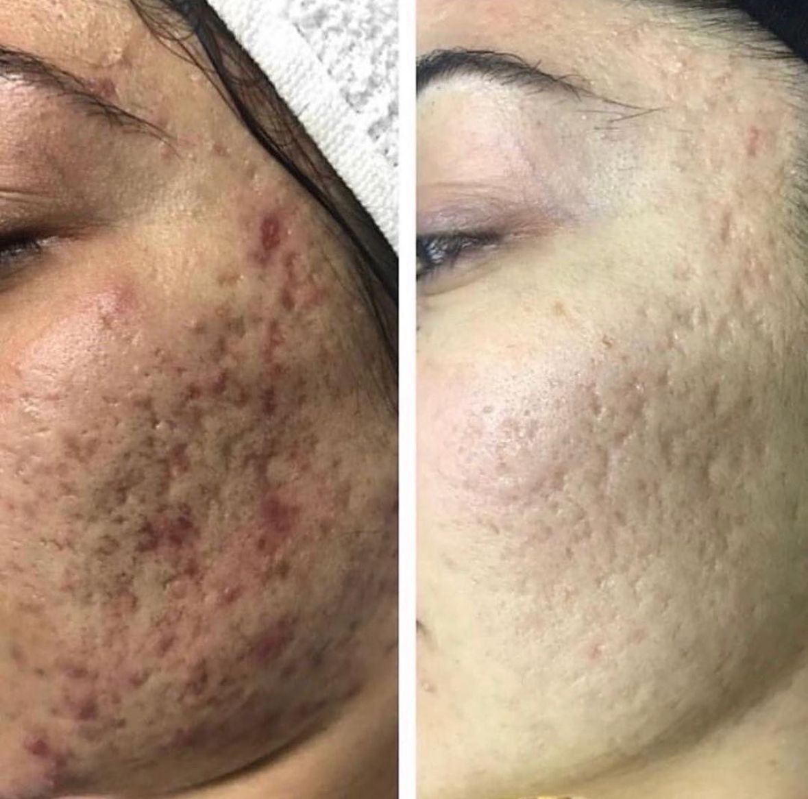 Before and after acne and post-acne mark comparison