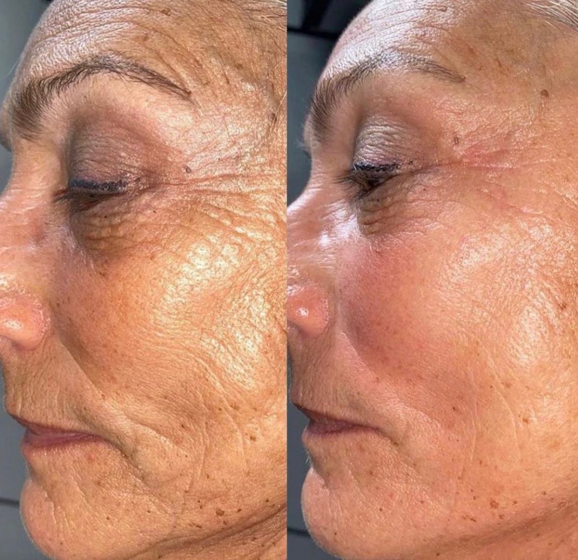 PHOTO 2025 01 17 10 21 50 Skin Ageing Before and after comparison of lines and skin texture