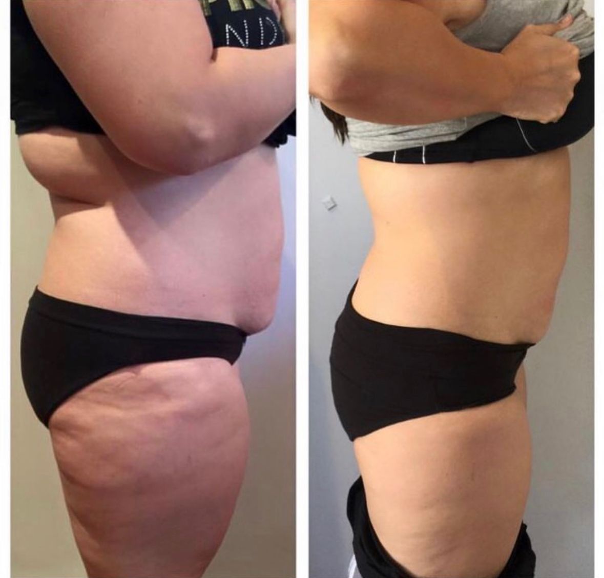 PHOTO 2025 01 17 10 40 22 2 Weight Loss Before and after side-profile body treatment comparison