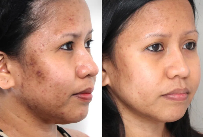 Before and after comparison showing improvement in facial pigmentation