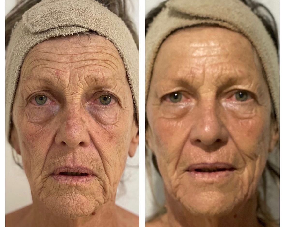 ae463af2 2efa 4f49 9901 bd3720207c58 Skin Ageing Before and after facial firmness comparison