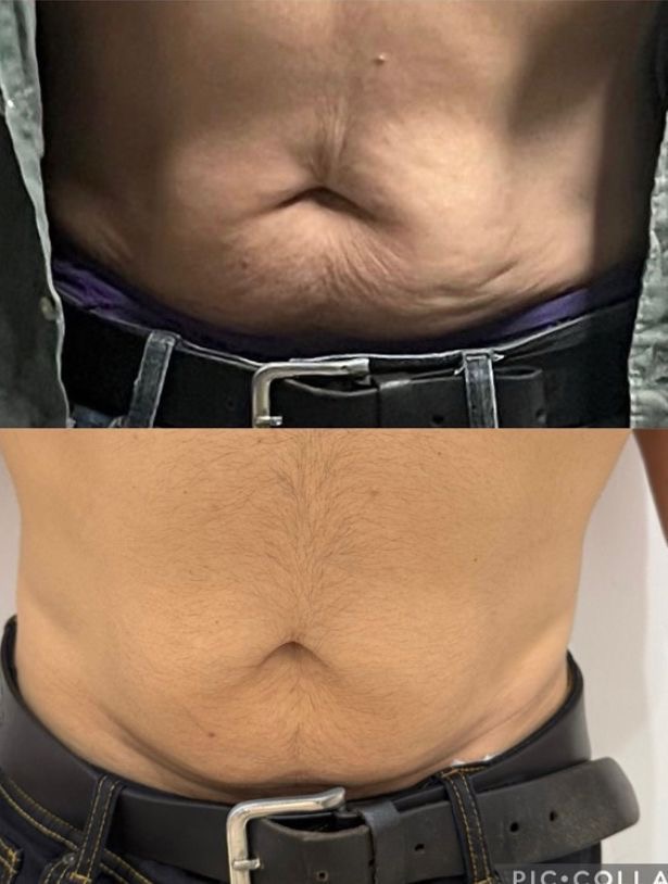 afcf2a19 1d06 4a87 b9ba a84b19f56f12 Weight Loss Before and after abdominal body treatment comparison