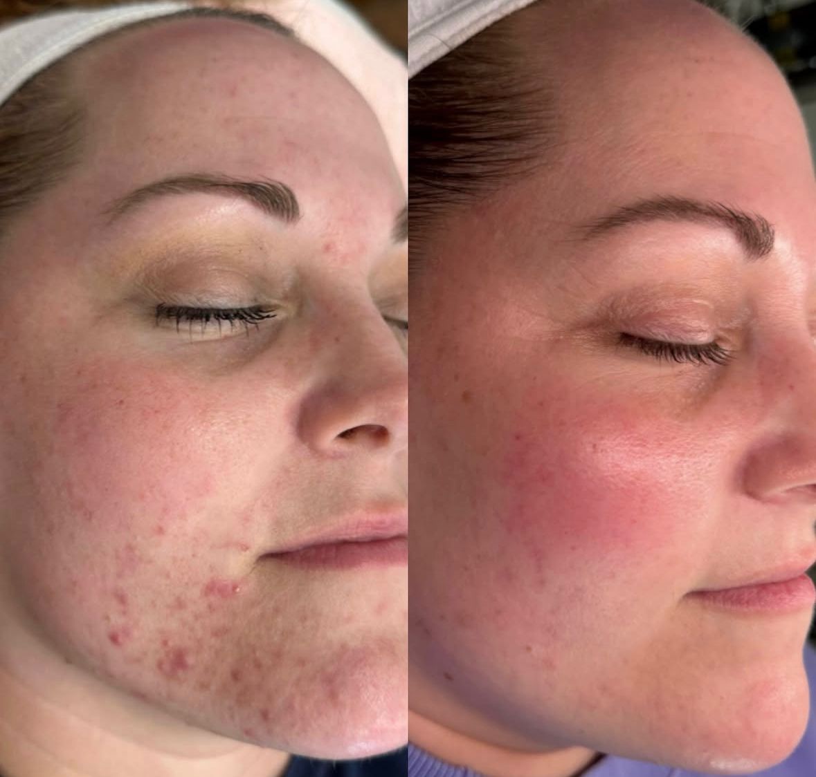 Before and after comparison showing calmer-looking acne-prone skin