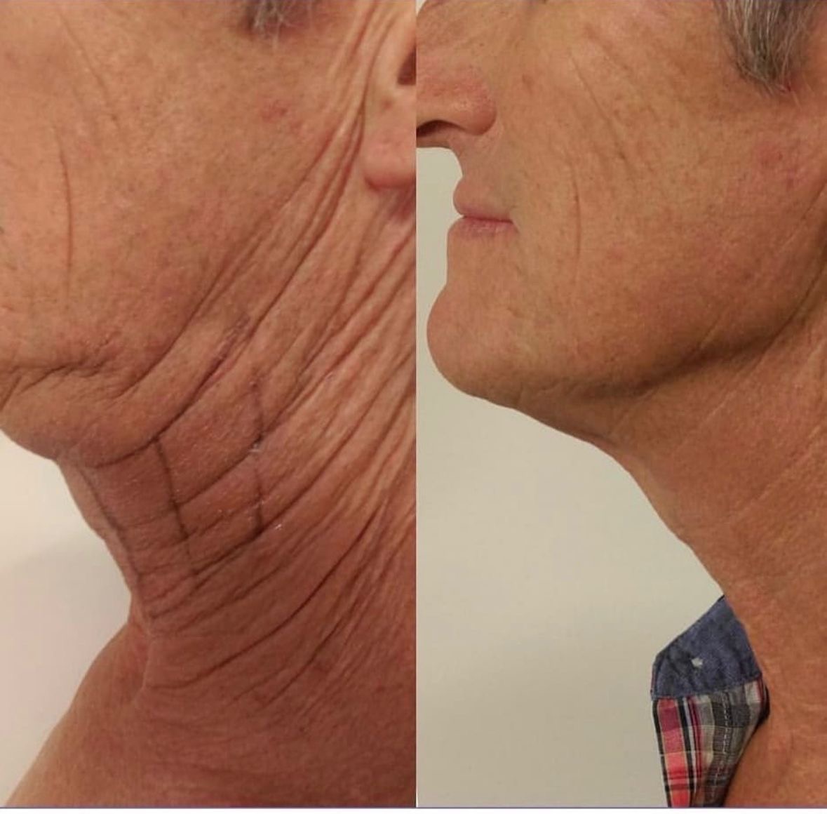 c1c7ac54 d9c7 4ecc 8fbf 8dede96d58cf Skin Ageing Before and after facial rejuvenation comparison