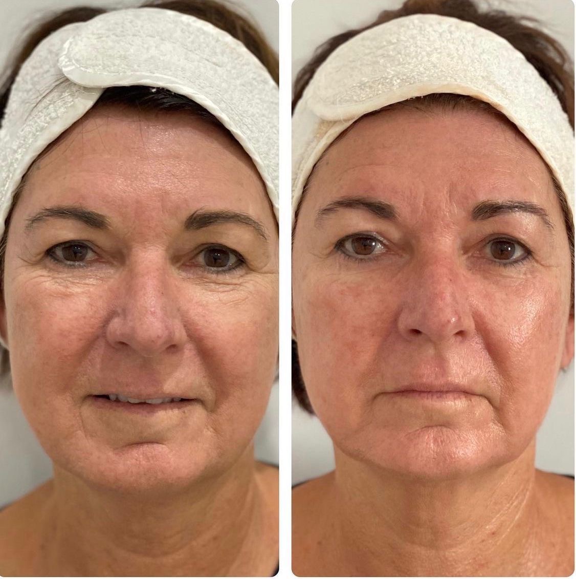 e491b0de 9e0c 473f 8c30 7587581cfc4f Skin Ageing Before and after skin texture comparison