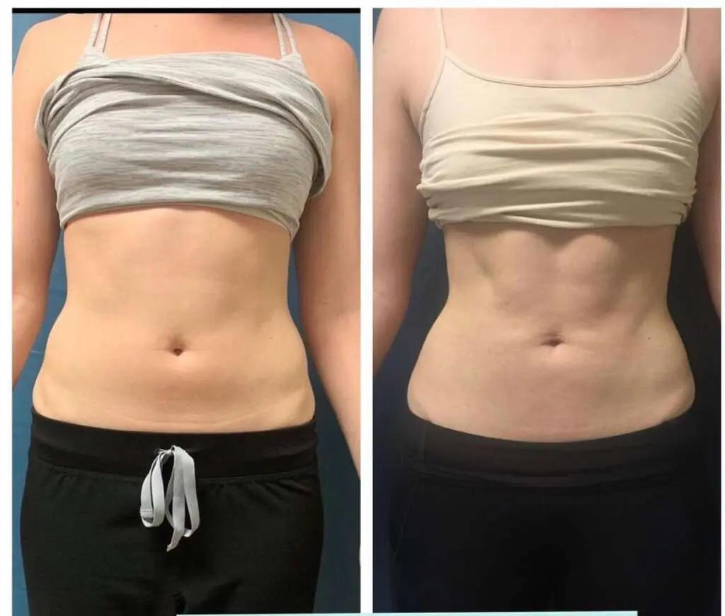 image 1 Weight Loss Before and after waist and abdominal treatment comparison