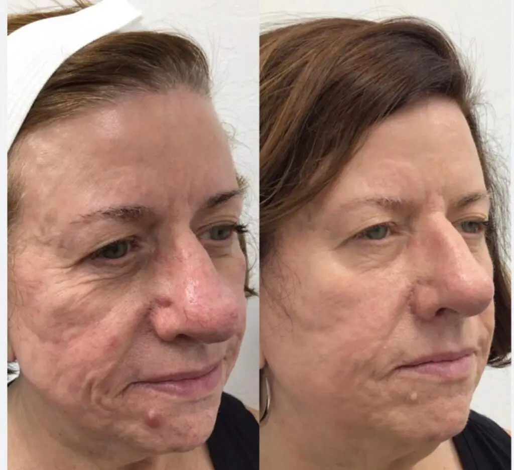 image 2 Skin Ageing Before and after facial skin treatment comparison