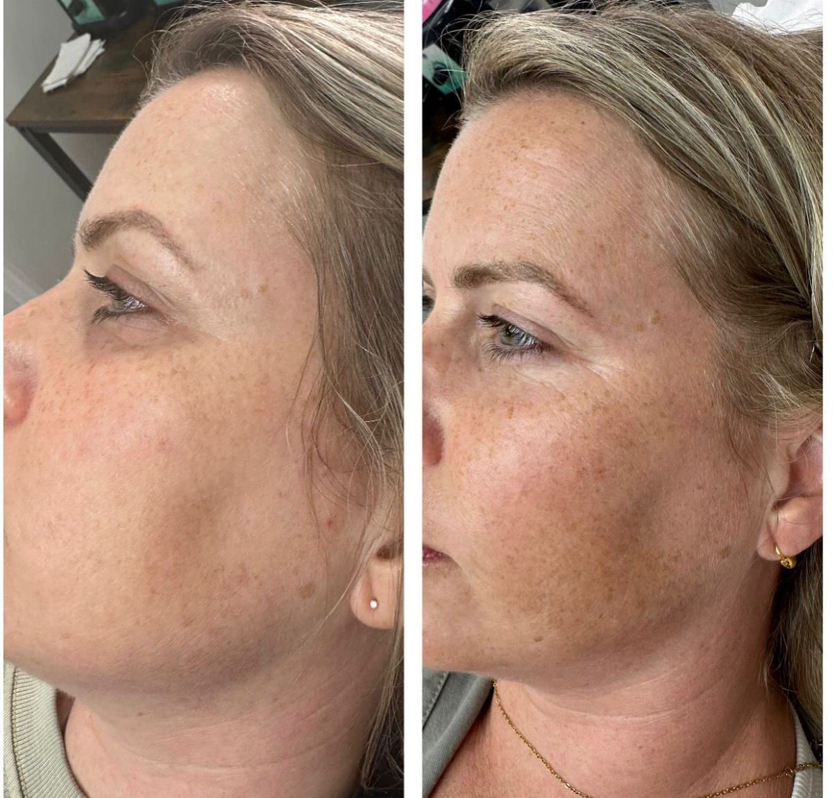 Before and after comparison of facial pigmentation and skin tone