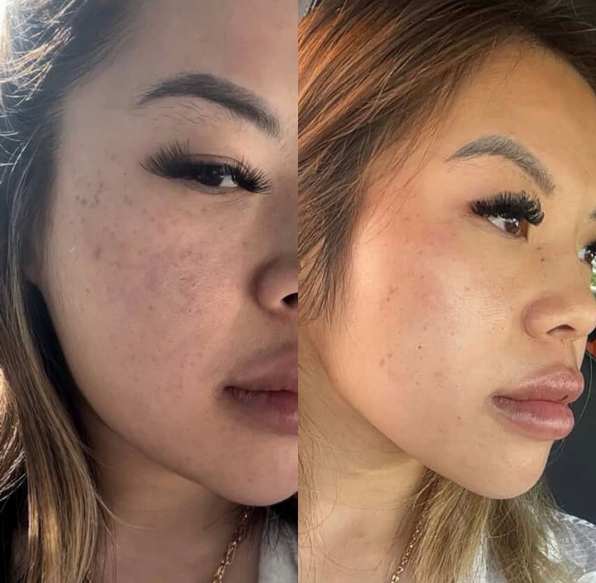Before and after comparison showing clearer-looking cheek pigmentation